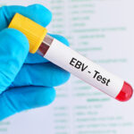 Hur Epstein-Barr utlöser MS. Den spännande kopplingen mellan Herpes, EBV mm, och allvarliga sjukdomar